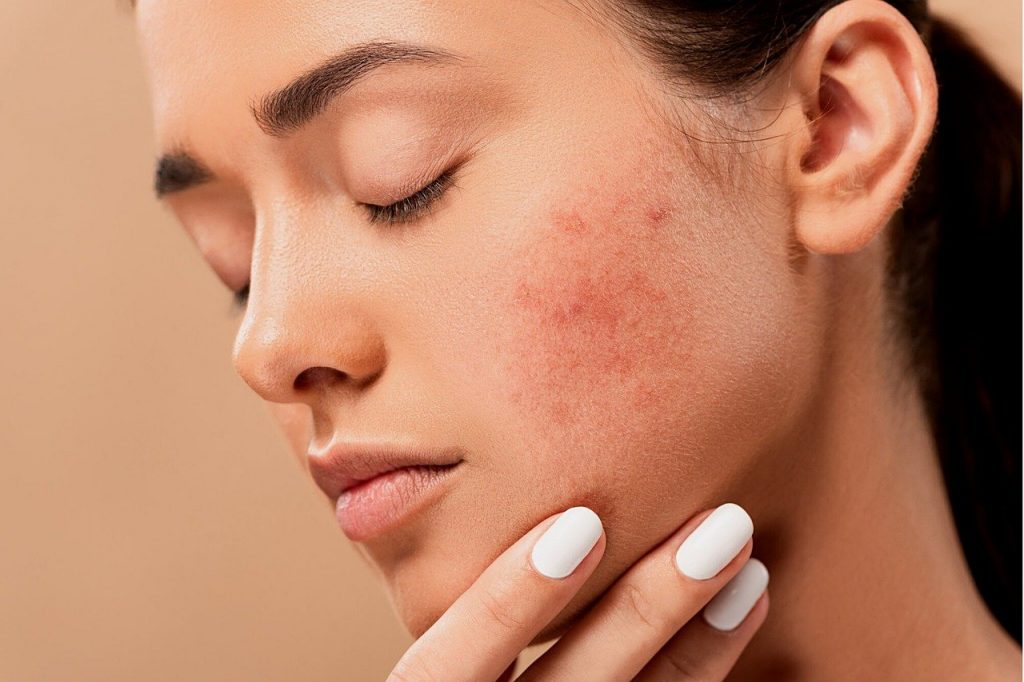 Acne Scars Reduction